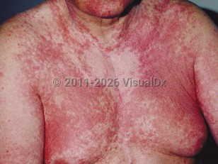Autoeczematization