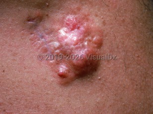Dermatofibrosarcoma protuberans