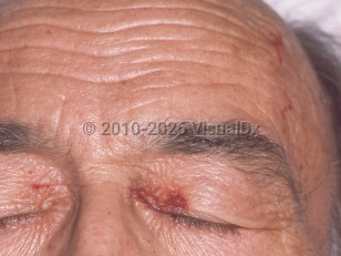 Clinical image of AL amyloidosis - imageId=91508. Click to open in gallery.  caption: 'Purpura on the medial eyelids and forehead.'