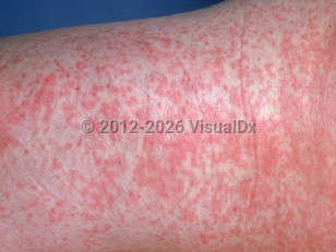 Clinical image of Rubella - imageId=915460. Click to open in gallery.  caption: 'A close-up of pink macules, papules, and patches on the thigh.'