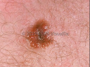 Spitz nevus