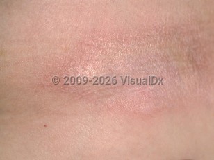 Morphea