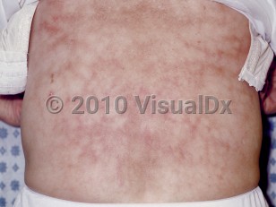 Erythema ab igne