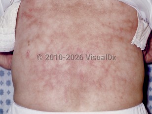 Erythema ab igne