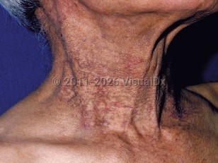 Pigmented contact dermatitis