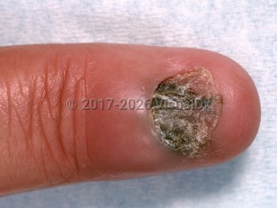 Chronic paronychia