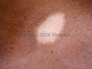 Clinical image of Postinflammatory hypopigmentation - imageId=95540. Click to open in gallery.  caption: 'A close-up of an oval white patch.'