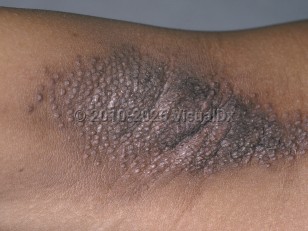Fox-Fordyce disease