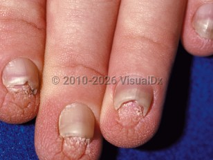 Hidrotic ectodermal dysplasia