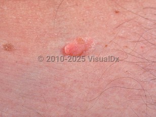 Fibroepithelioma of Pinkus