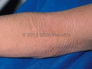Bullous congenital ichthyosiform erythroderma