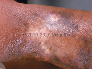 Lymphangiosarcoma