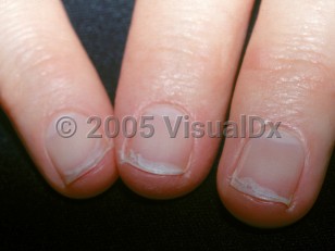 Search Results: Toenails, Scattered nails or distal digits, Shortened  broken nail, Onycholysis - lifting nail, 2 - 12 year old female