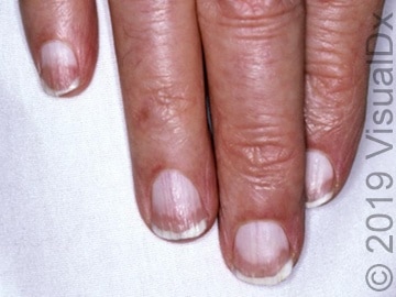 Nail The Diagnosis Of Half And Half Nails Visualdx Nail The Diagnosis Of Half And Half Nails Visualdx