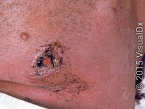 Cutaneous Anthrax presenting on a human
