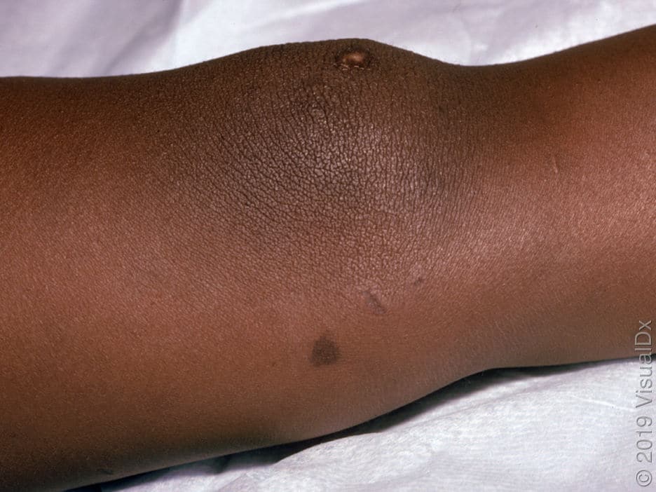 Acute Meningococcemia on dark skin, as seen in VisualDx dark skin dermatology atlas