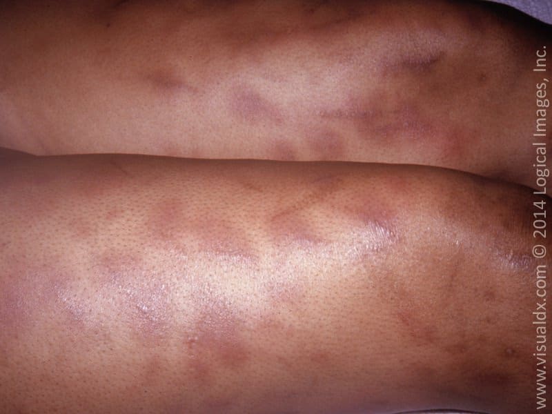 Sepsis Rash Leg Being Proactive about Sepsis | VisualDx