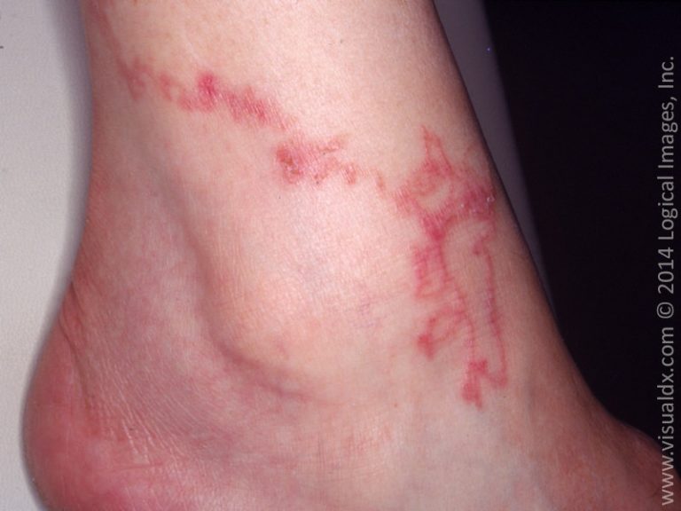 Medical Student IDs Serpiginous Lesions With VisualDx