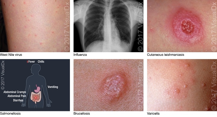 Infectious Diseases Contracted During Military Service | VisualDx