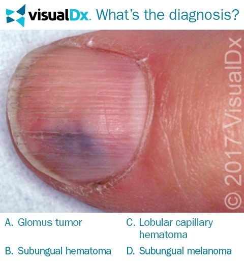 What caused a painful purple spot under this woman's fingernail? - Can You  Diagnose? | VisualDx