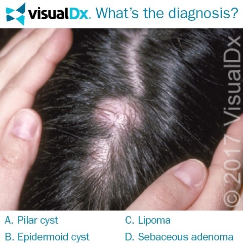 Woman Has Slow-Growing Lump on Her Scalp - Let's Diagnose | VisualDx