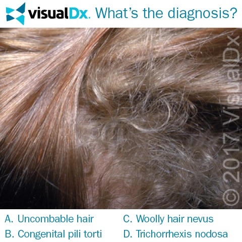 Boy's Unruly Patch of Hair - What's the Diagnosis? | VisualDx