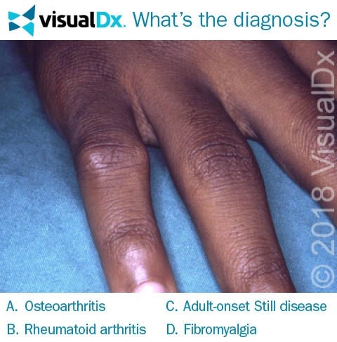 Woman S Finger Joint Pain Decreases With Movement Let S Diagnose Visualdx