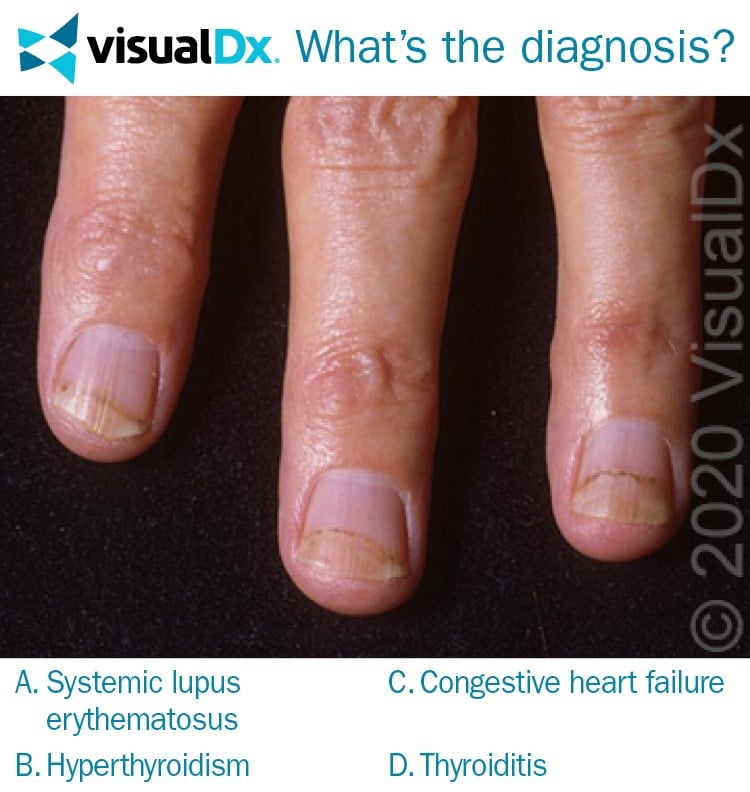 Women Has Fatigue Heat Intolerance Lifting Fingernails Let s Diagnose VisualDx