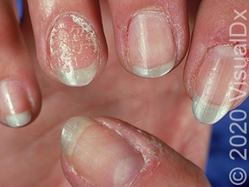 Dents fingernails tiny in What is