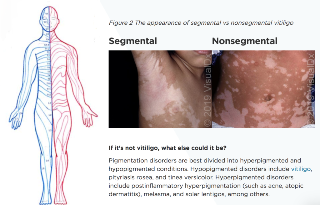 Spotting the Diagnosis of Vitiligo VisualDx