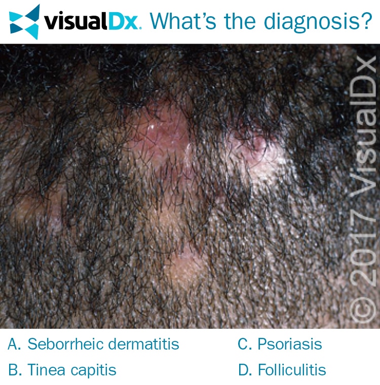 Boy has areas of alopecia, scaly plaques on scalp Let’s Diagnose