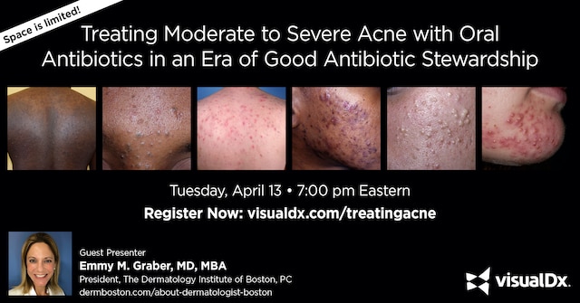 Treating Moderate-to-Severe Acne With Oral Antibiotics in an Era Of Good Antibiotic Stewardship