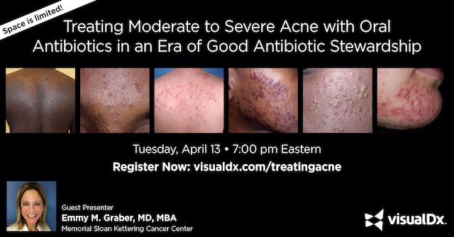 Treating Moderate-to-Severe Acne With Oral Antibiotics in an Era Of Good Antibiotic Stewardship