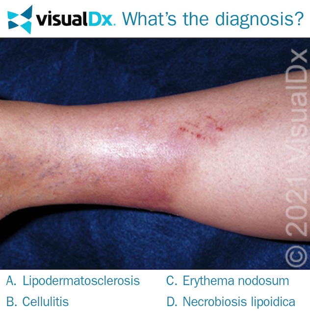 Woman Develops Painful Plaque on Lower Leg Let’s Diagnose