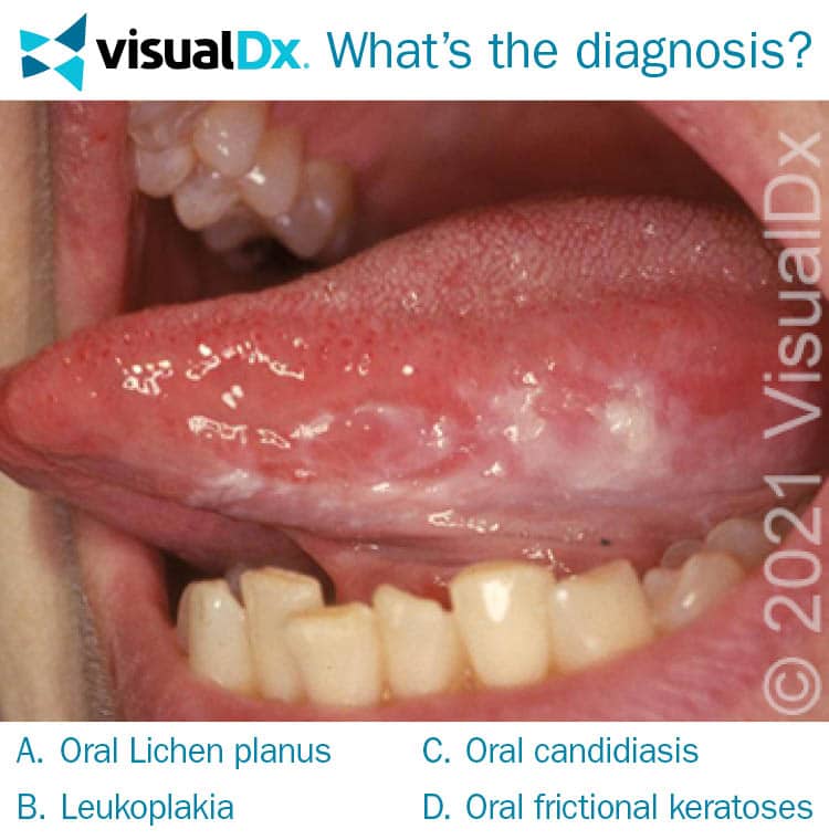 White Oral Plaque in Cigarette Smoker Let’s Diagnose