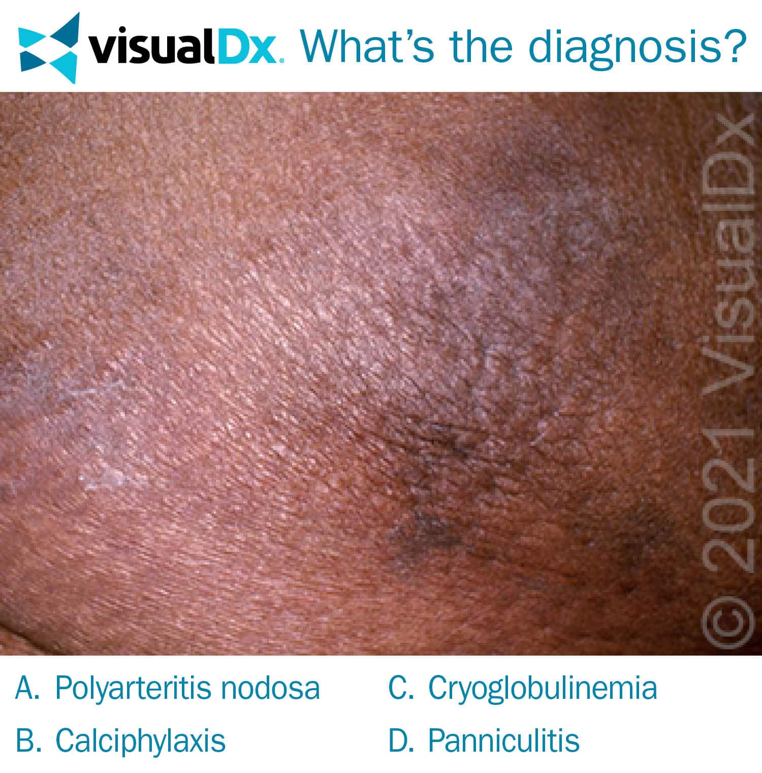 Sudden Onset of Painful, Dark Lesions - Let’s Diagnose
