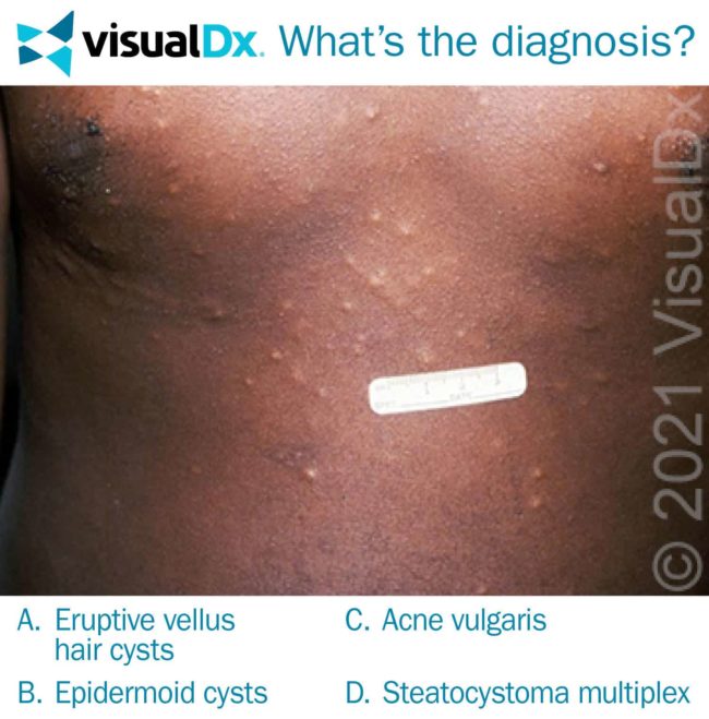 Cystic Lesions on Man’s Chest Let’s Diagnose