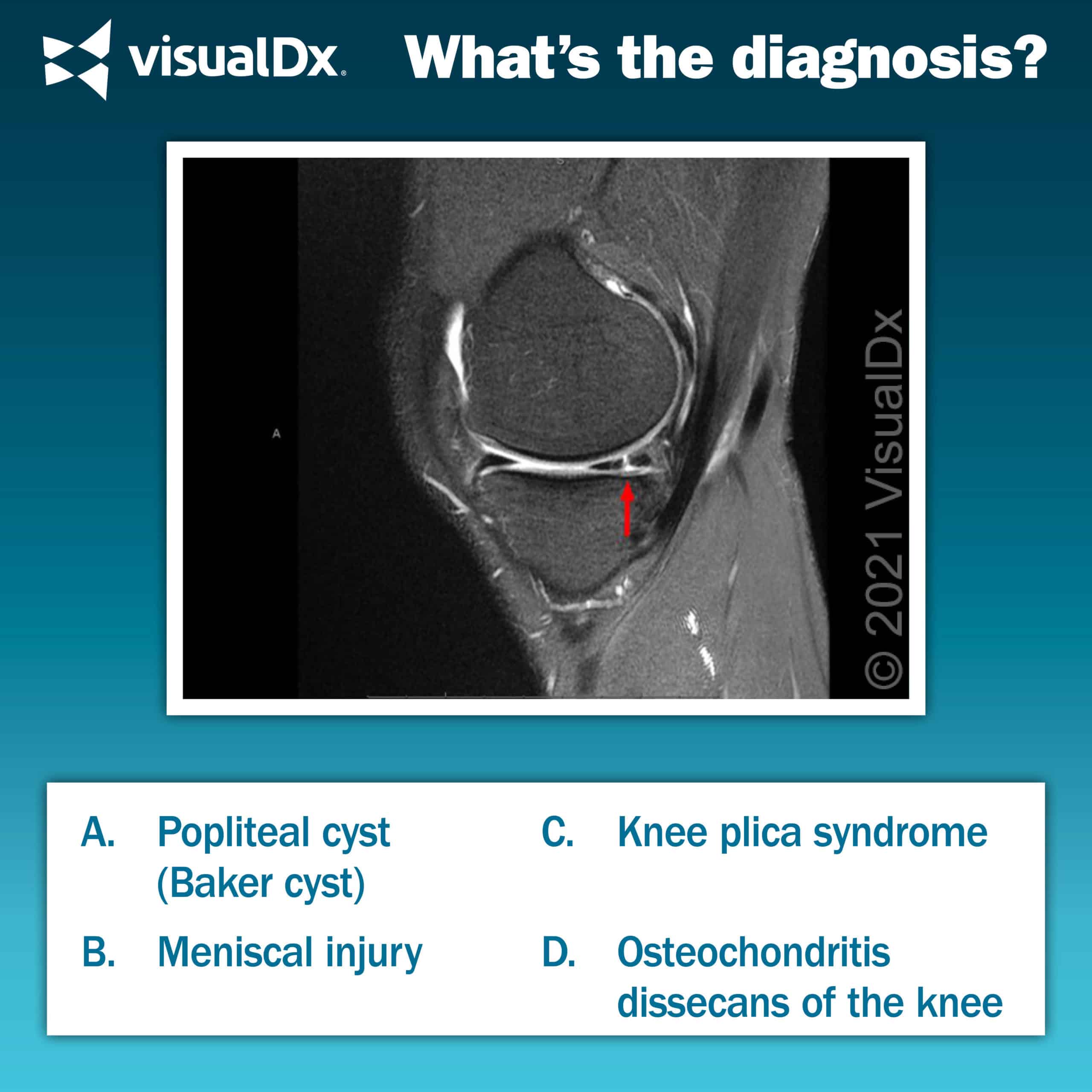 Soccer Player With Knee Pain, Edema – Let’s Diagnose