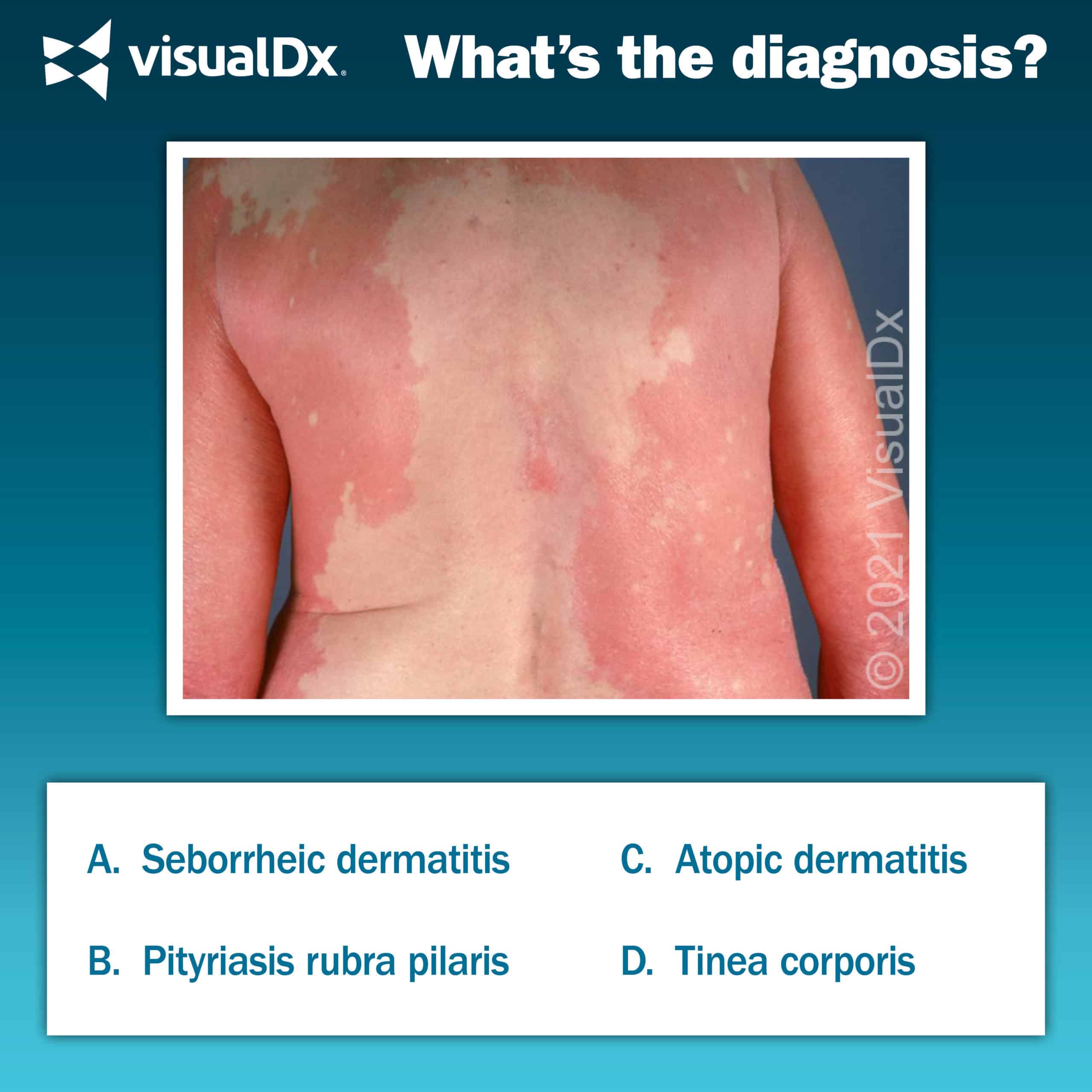 Truncal Rash Area Truncal Rash with Islands of Sparing - Let’s Diagnose