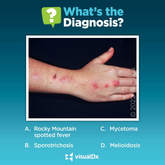 Brazilian landscaper with nodules in linear configuration on hand – Let’s diagnose