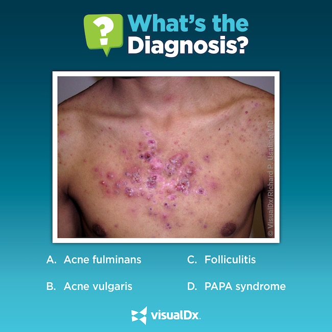 Young bodybuilder with painful pustules on chest Let’s diagnose