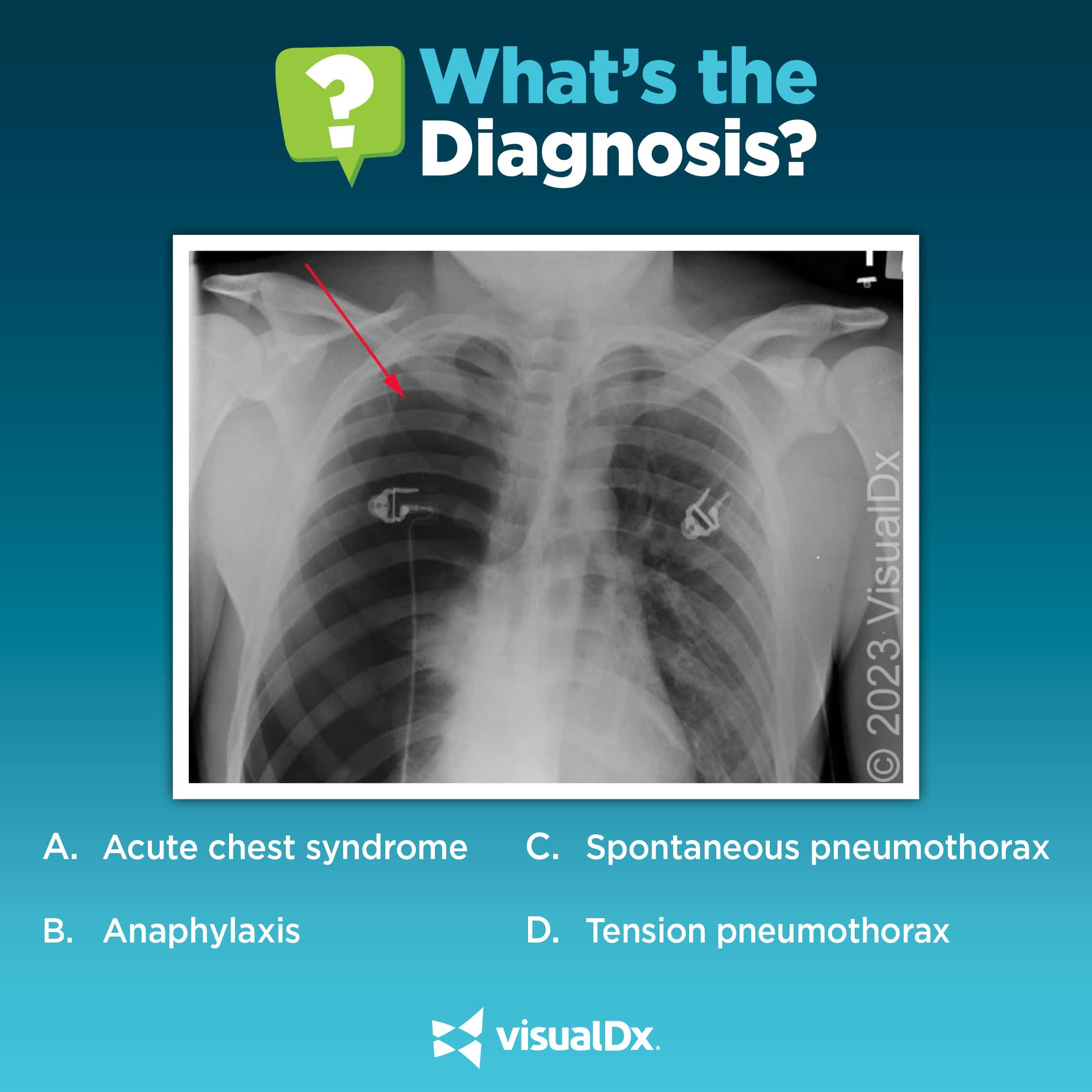 Dx Challenge Teen athlete with chest pain, cough, and dyspnea. VisualDx